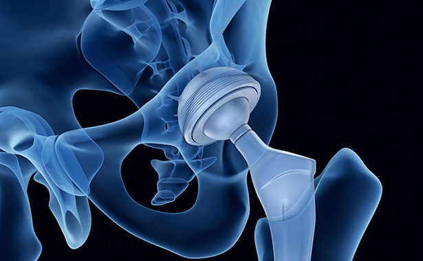Innovative digitale Prothesenplanung Peekmed
