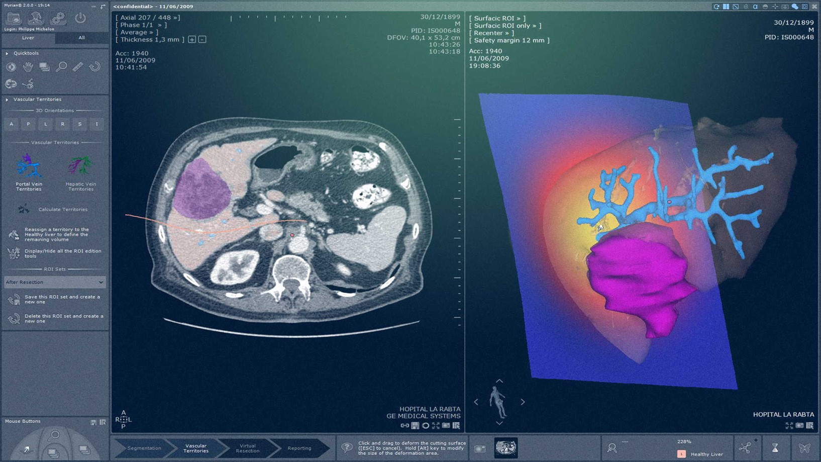 Example of liver planning module