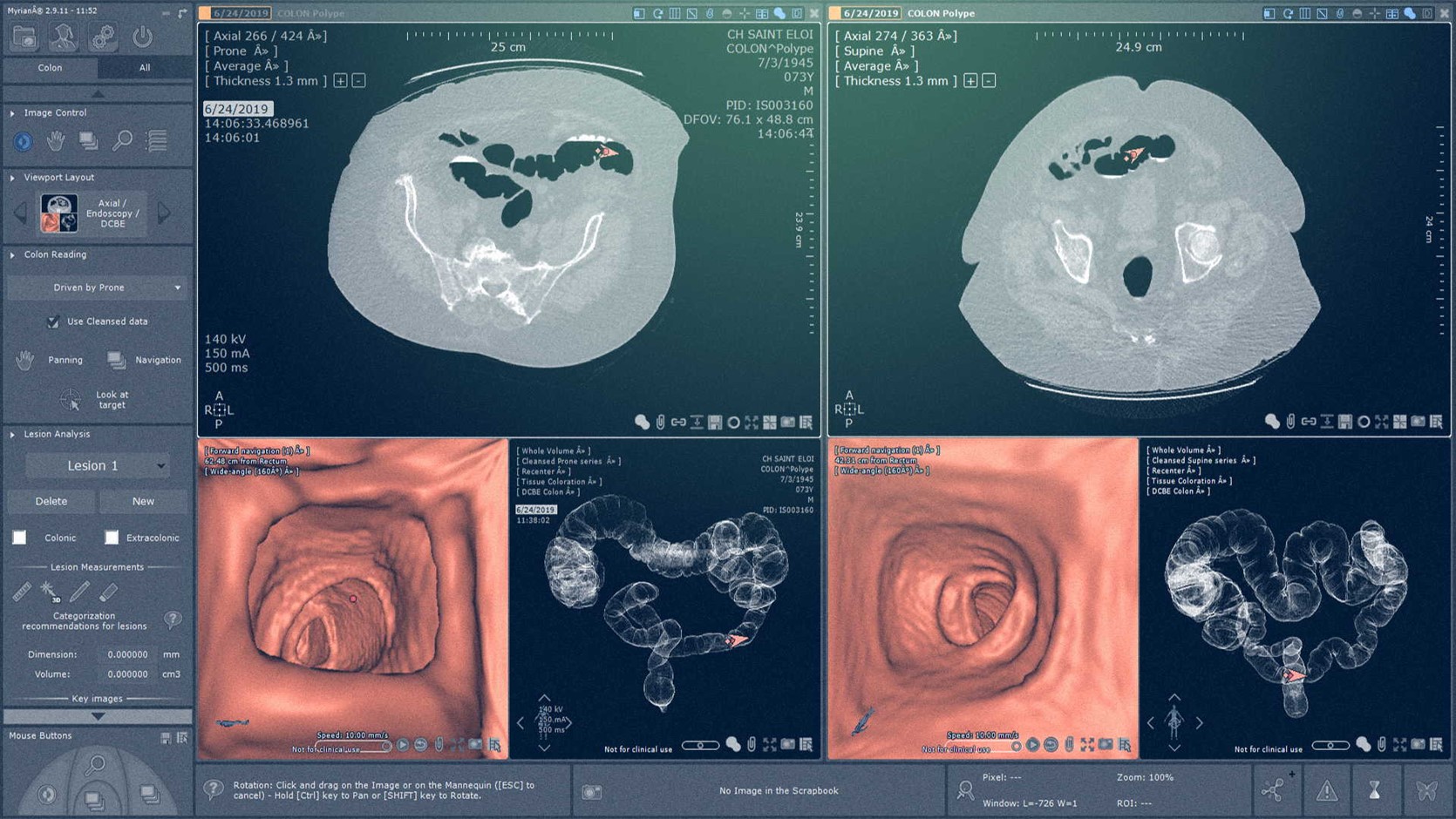 Example of virtual colonoscopy