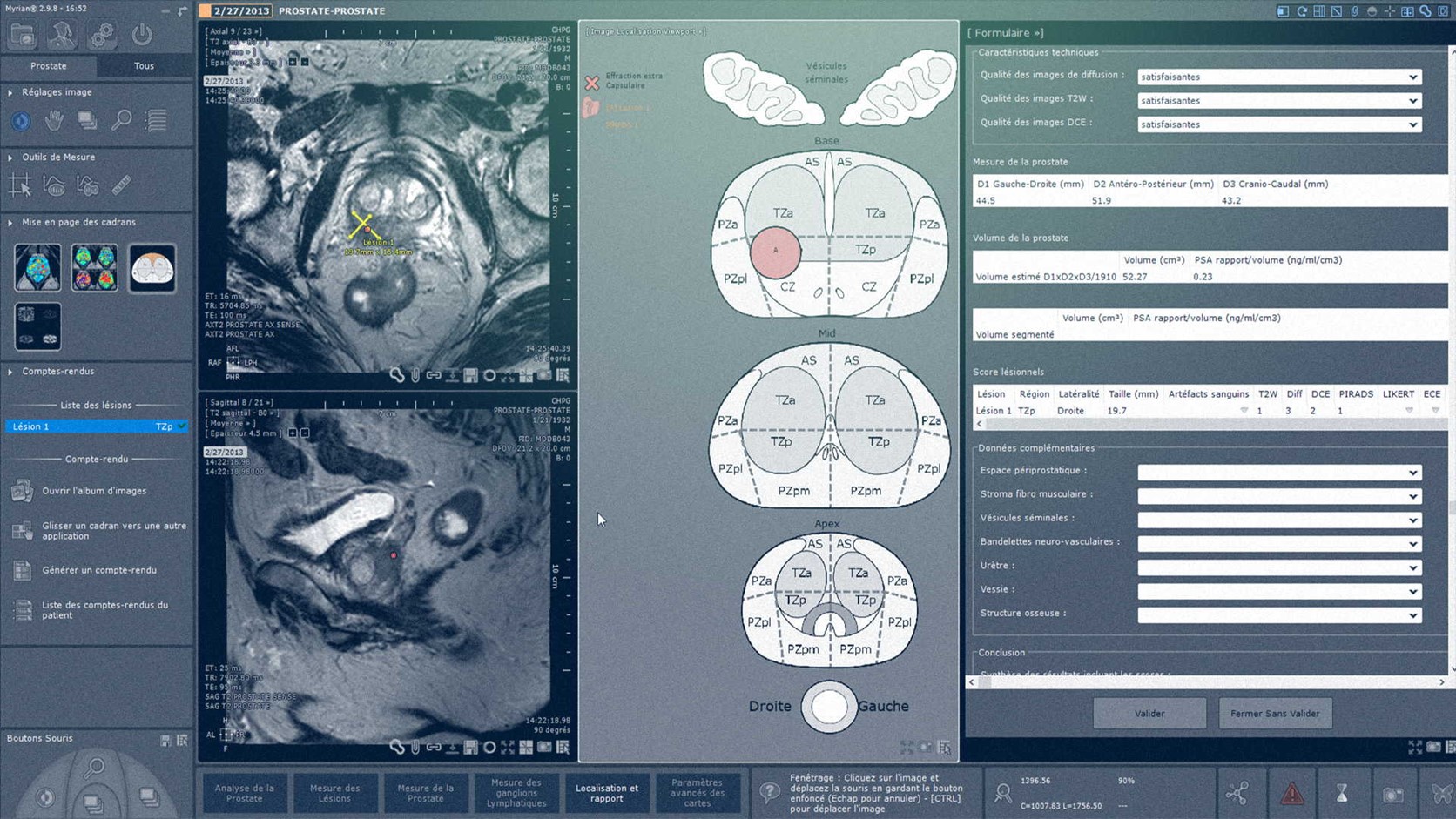 Example of MR prostate reporting